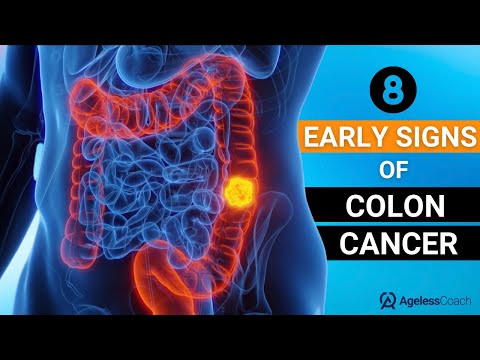 The 8 Early Signs Of Colon Cancer You Should Know At Any Age [Video]