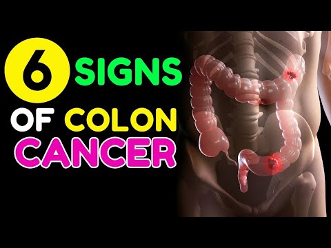 6 Warning Signs You Should Never Ignore For Colon Cancer |  6 Signs Of Colon Cancer [Video]