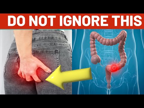 10 Early Warning Signs of Colon Cancer You Can’t Ignore [Video]