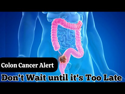 The Silent Killer: Warning Signs Of Colon Cancer | Red Flags in the Colon [Video]