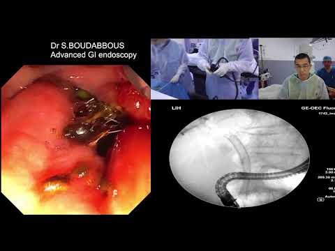 Acute severe cholangitis 8 month after SEMS for advanced Pancreatic cancer. [Video]