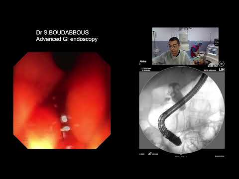 ERCP for advanced metastatic pancreatic cancer [Video]