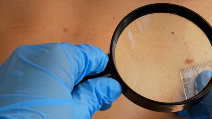 Skin Cancer Awareness Month: Doctors Emphasize the Importance of Sunscreen Usage [Video]