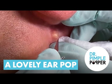A Lovely Ear Pop [Video]