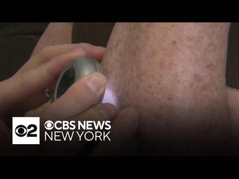 Not enough people taking right precautions against skin cancer, dermatologists say [Video]
