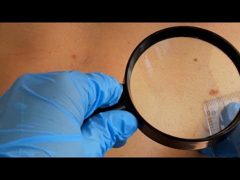 Skin Cancer Awareness Month: Doctors Emphasize the Importance of Sunscreen Usage [Video]