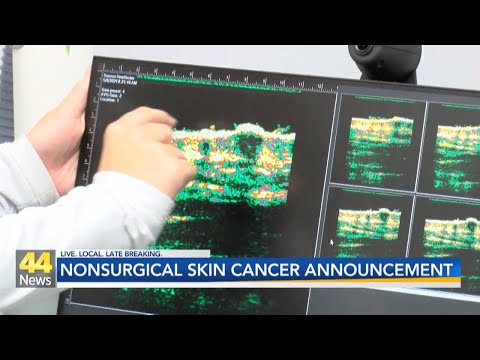 Evansville gets advanced nonsurgical treatment for common skin cancer [Video]