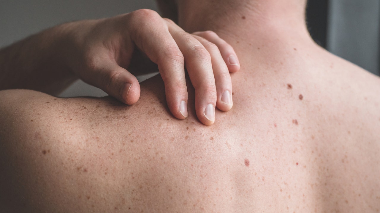 Dermatologist shares tips on preparing for a skin cancer check [Video]