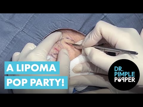 A Lipoma Pop Party! [Video]