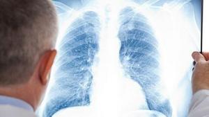 Immunotherapy Before and After Surgery Boosts Lung Cancer Survival [Video]