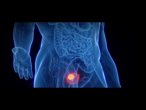 Health Watch: Bladder Cancer [Video]