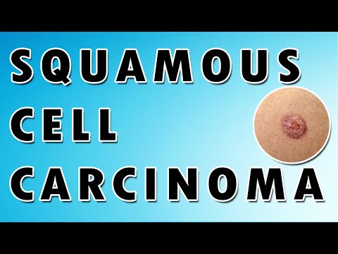 Squamous Cell Carcinoma [Video]