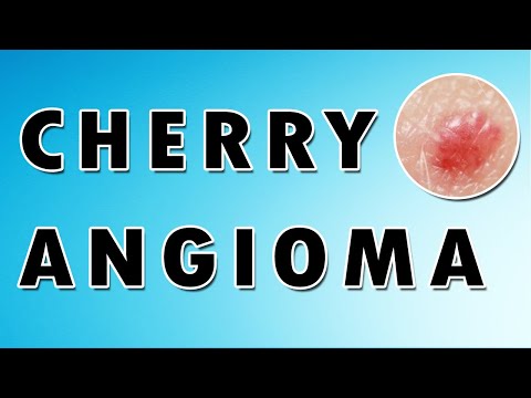 Cherry Hemangioma Symptoms, Treatment, and Causes [Video]