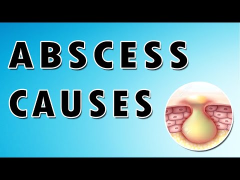 Abscess Symptoms, Treatment, and Causes [Video]