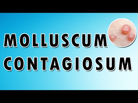 Molluscum Contagiosum Symptoms and Treatment [Video]