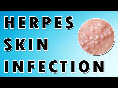 Herpes Simplex Virus Symptoms and Treatment [Video]