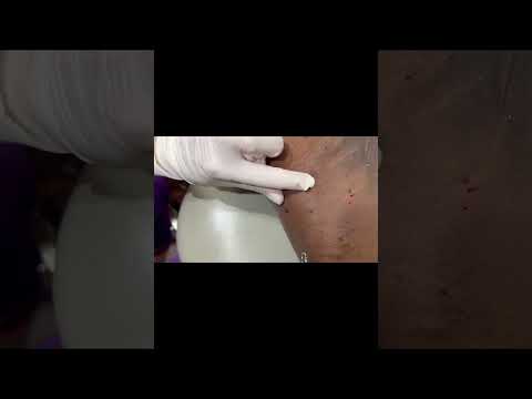 Arm Pit Comedones [Video]