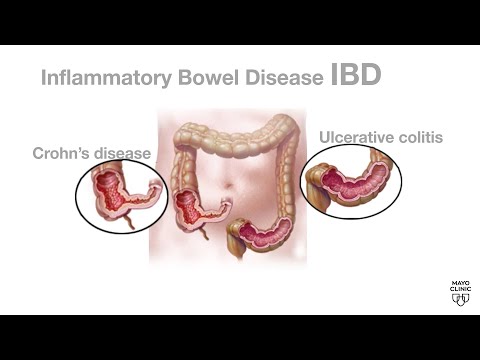 Mayo Clinic Minute: What is inflammatory bowel disease? [Video]