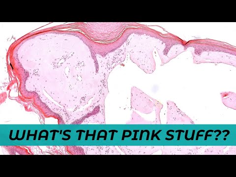 What’s that Pink Stuff??? Lipoid proteinosis vs Amyloidosis vs Colloid Milium (dermpath pathology) [Video]