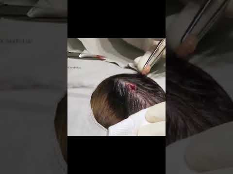 2 of the 3 egg noodle cysts we extracted - full video linked to watch the rest!