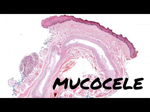 Mucocele (Bump on Lip from ruptured salivary gland/duct) oral pathology dermpath [Video]