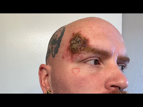End Of Week 5 Superficial Basal Cell Carcinoma (Skin Cancer) Aldara Treatment [Video]