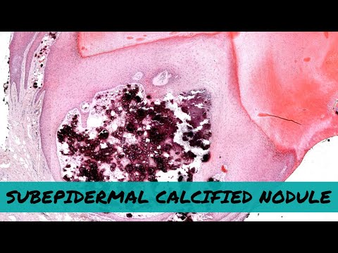 Subepidermal Calcified Nodule (eyelid face skin bump in kids – a type of calcinosis cutis) dermpath [Video]