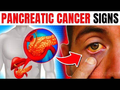 12 EARLY Warning Signs Of Pancreatic Cancer You Are Ignoring! [Video]