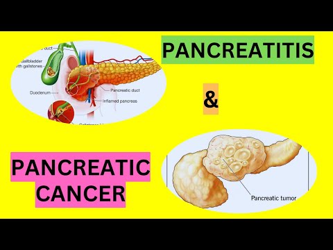 DIAGNOSIS OF PANCREATITIS &PANCREATIC CANCER [Video]