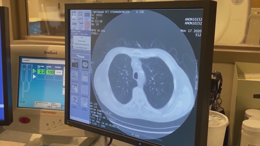 Lung cancer screening as critical as mammogram, colonoscopy [Video]