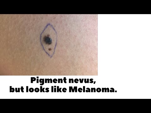 Pigment nevus, but it looks like melanoma. [Video]