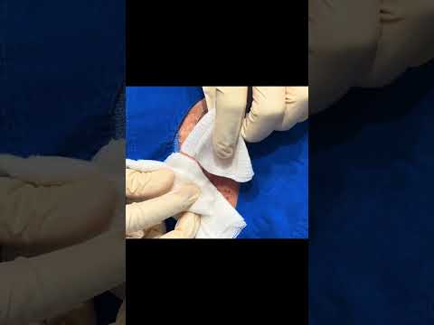 A Quick Little Cyst [Video]