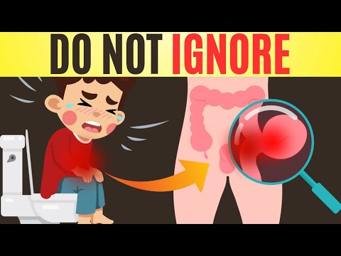 5 Warning Signs of Colon Cancer You Shouldn’t Ignore | [Video]