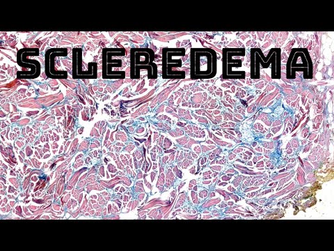 Scleredema (firm hard thick skin on upper back) with colloidal iron mucin/myxoid stain [Video]