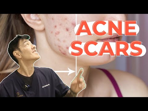 How to Treat Pigmented Acne Scars | Dr Davin Lim [Video]