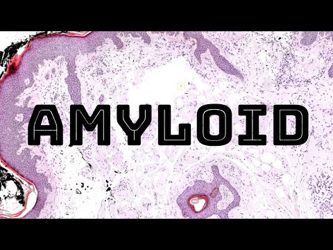 Amyloid under the microscope (nodular vs systemic amyloidosis AL light chain) dermpath pathology [Video]