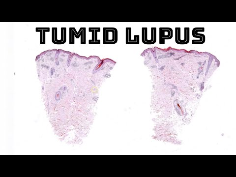 Tumid lupus erythematosus (red firm skin plaques nodules on trunk) pathology dermpath [Video]