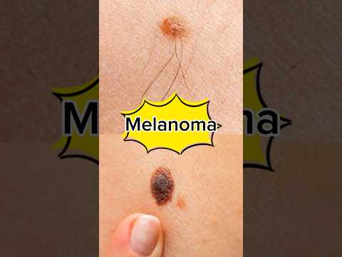 What is Melanoma | Melanoma diagnosis,treatment and risk factors#melanoma [Video]