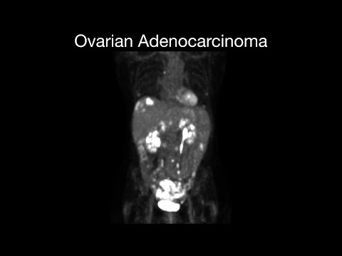 Ovarian Adenocarcinoma [Video]