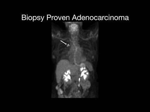Biopsy Proven Adenocarcinoma [Video]