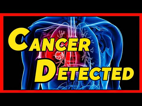 Lung Cancer Diagnosis Using AI | Promising Clinical Trials [Video]