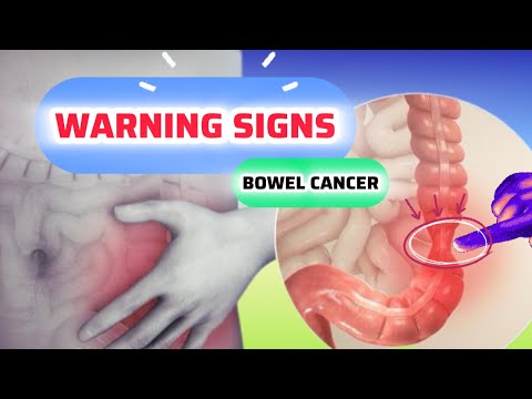BOWEL CANCER Or COLON CANCER – Signs – Symptoms – Causes – Investigations – Diagnosis – Treatment [Video]