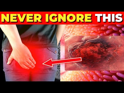8 EARLY Warning Signs Of Colon Cancer You MUST NOT IGNORE! ⚠️ [Video]