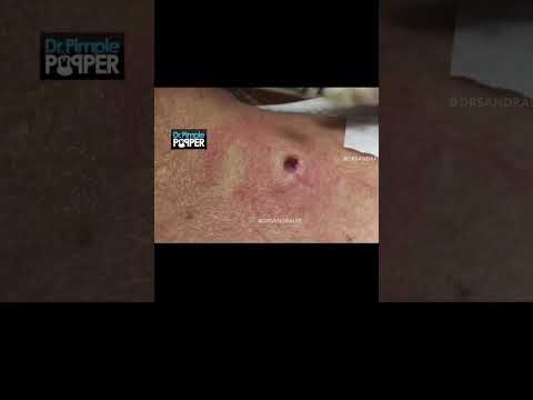 DPOW = Dilated Pore of Winer = GIANT blackhead bliss. Looks like a kitchen sink plug, huh? [Video]