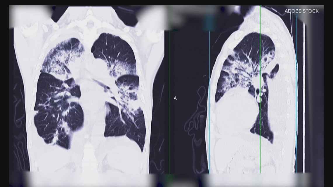 How lung cancer screenings could save your life [Video]